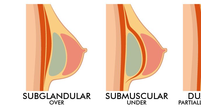 Breast Augmentation Incision| Everything you need to know